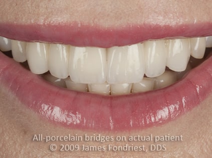 Zirconium dental bridgework, zirconium bridge, dental bridge before and after Zirconium dental bridgework, zirconium bridge, dental bridge before and after