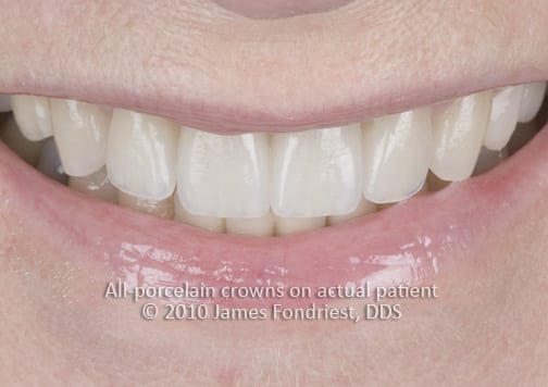 Pressed Lithium Disilicate Crowns Smile