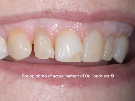 spaces or diastemas between teeth, gapped teeth