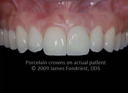 Procera crowns, aluminum oxide based crowns, aluminum oxide copings