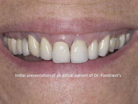 Patient needing reconstructive dentistry, Gummy smile