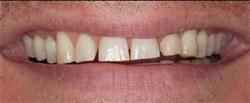 Fig. 2 TREATMENT PLANNING - The patient had little time to invest in treatment and little desire to extend treatment beyond a short time commitment (his wedding date). He wanted to know how little drilling could be done with the greatest impact on his smile. He was highly aware, well-versed on treatment options available in the current market, and wanted involvement in treatment decisions.