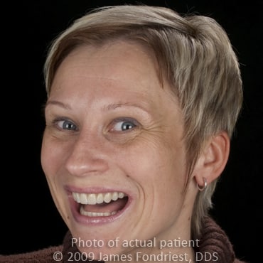 straighten teeth with veneers, veneers to shape teeth, Northfield resident straighten teeth with veneers, veneers to shape teeth, Northfield resident