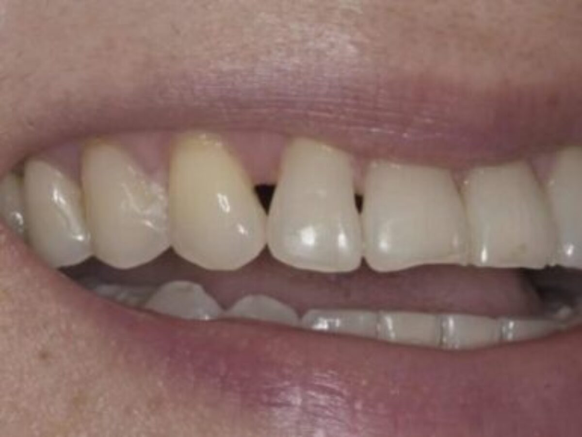 cavities between front teeth