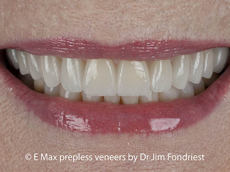 Cover stained teeth with Emax