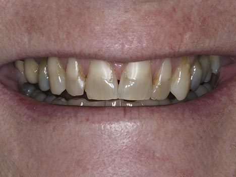 Stained Teeth | Cosmetic solutions to brighten your smile