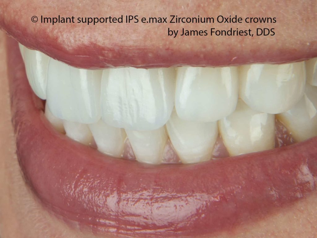 Strongest Implant crowns