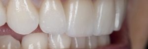 Veneer placement process