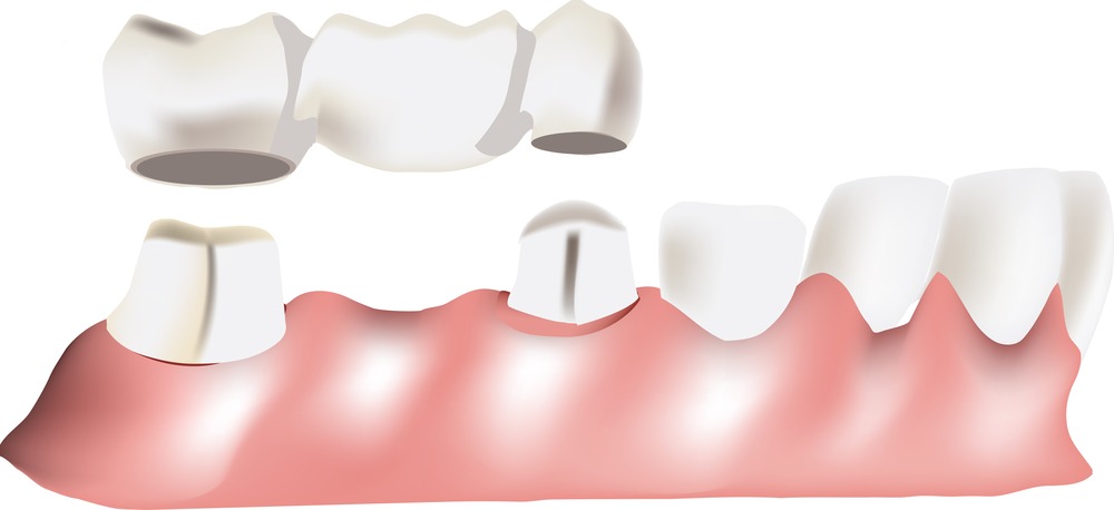 Do Dental Bridges Cause Bad Breath?