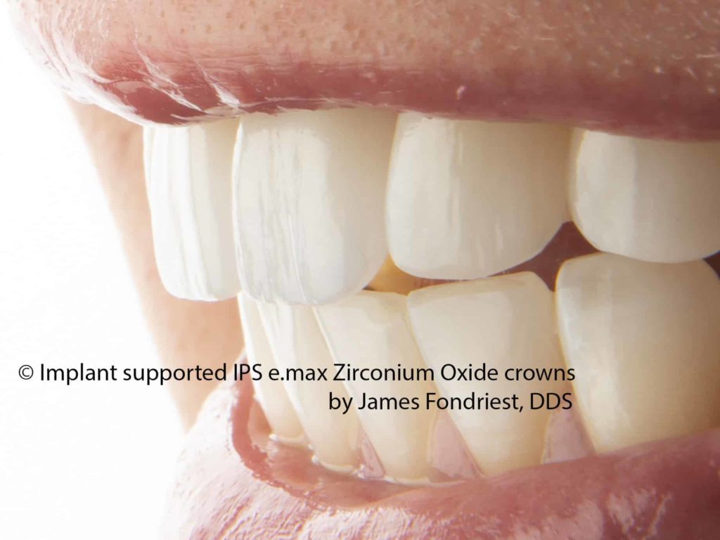 Zirconium Implant crowns Implant crowns