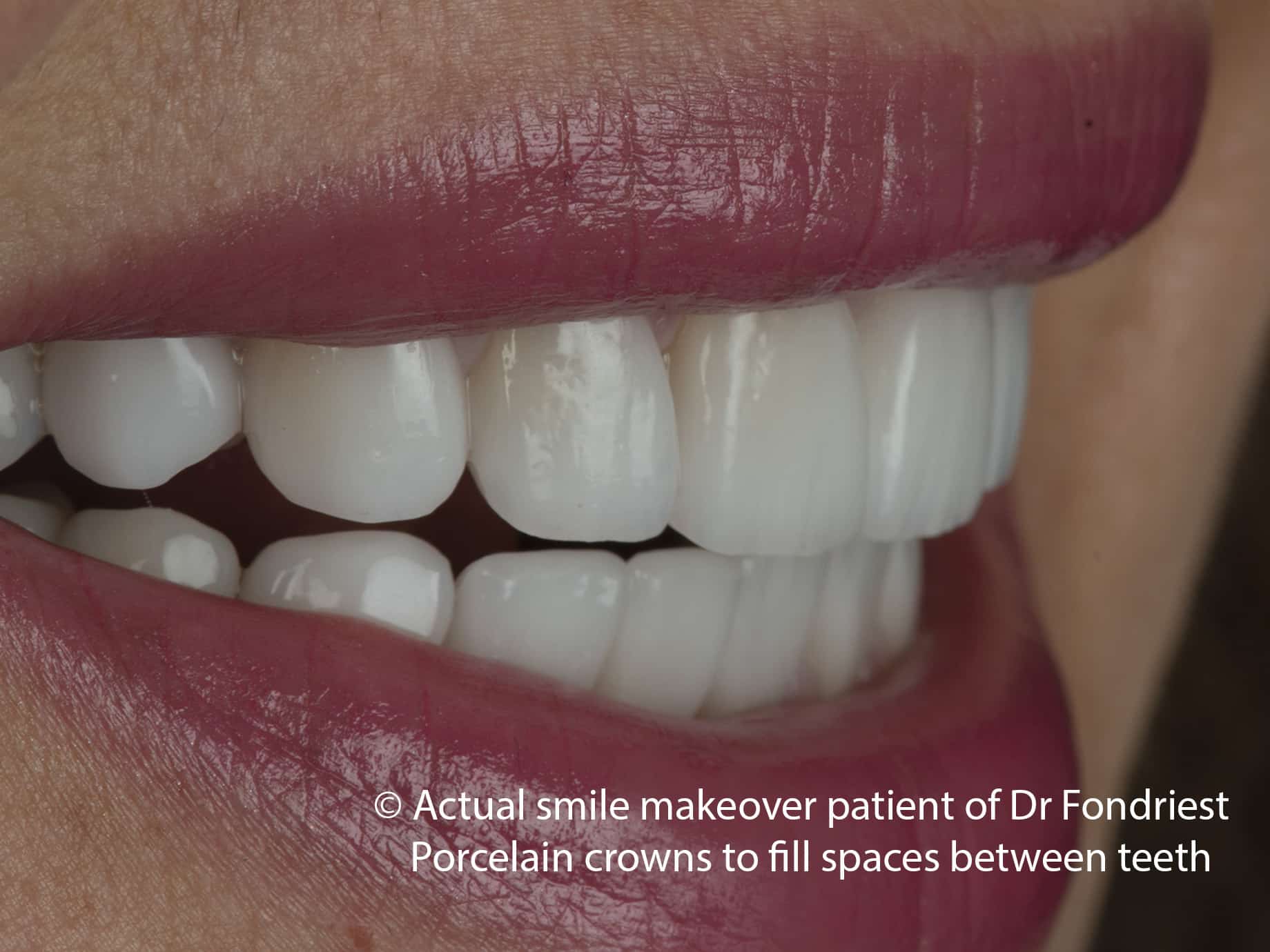 Fill spaces between teeth with crowns