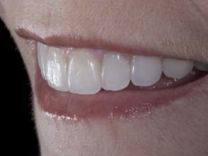 porcelain veneers