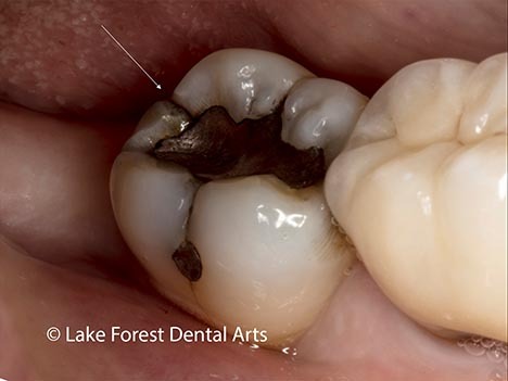 Horizontal crack in tooth