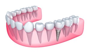 Best Way to Replace Teeth