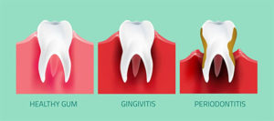 stages of periodontal disease