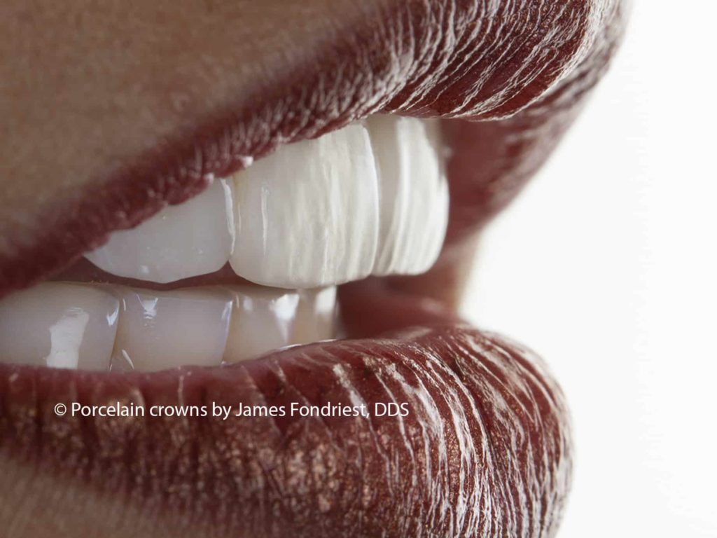 Porcelain on metal crowns Porcelain on Metal Crowns