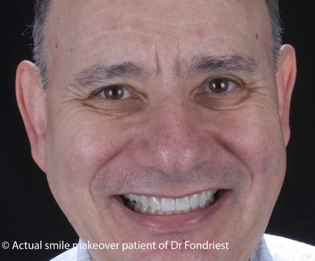 dental crowns that have been placed on patient's upper front teeth Placing a dental crown