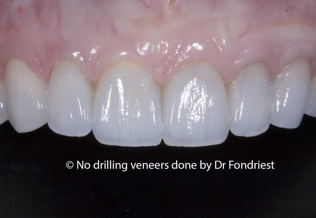 No preparation porcelain veneers no prep veneers