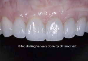 no prep veneers