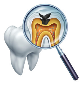 cavities occur without good cavity prevention