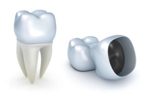 illustration of PFM crowns