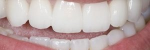Teeth Crowns