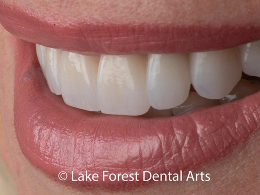smile makeover done with teeth crowns