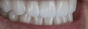 Caring for dental porcelain
