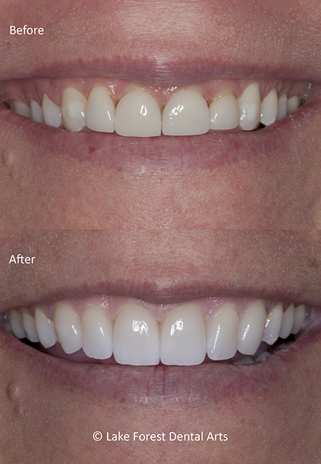 gum recontouring for teeth makeover
