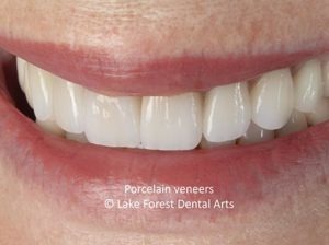 Questions About Veneers
