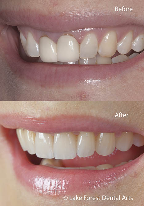 Smile makeover before and after