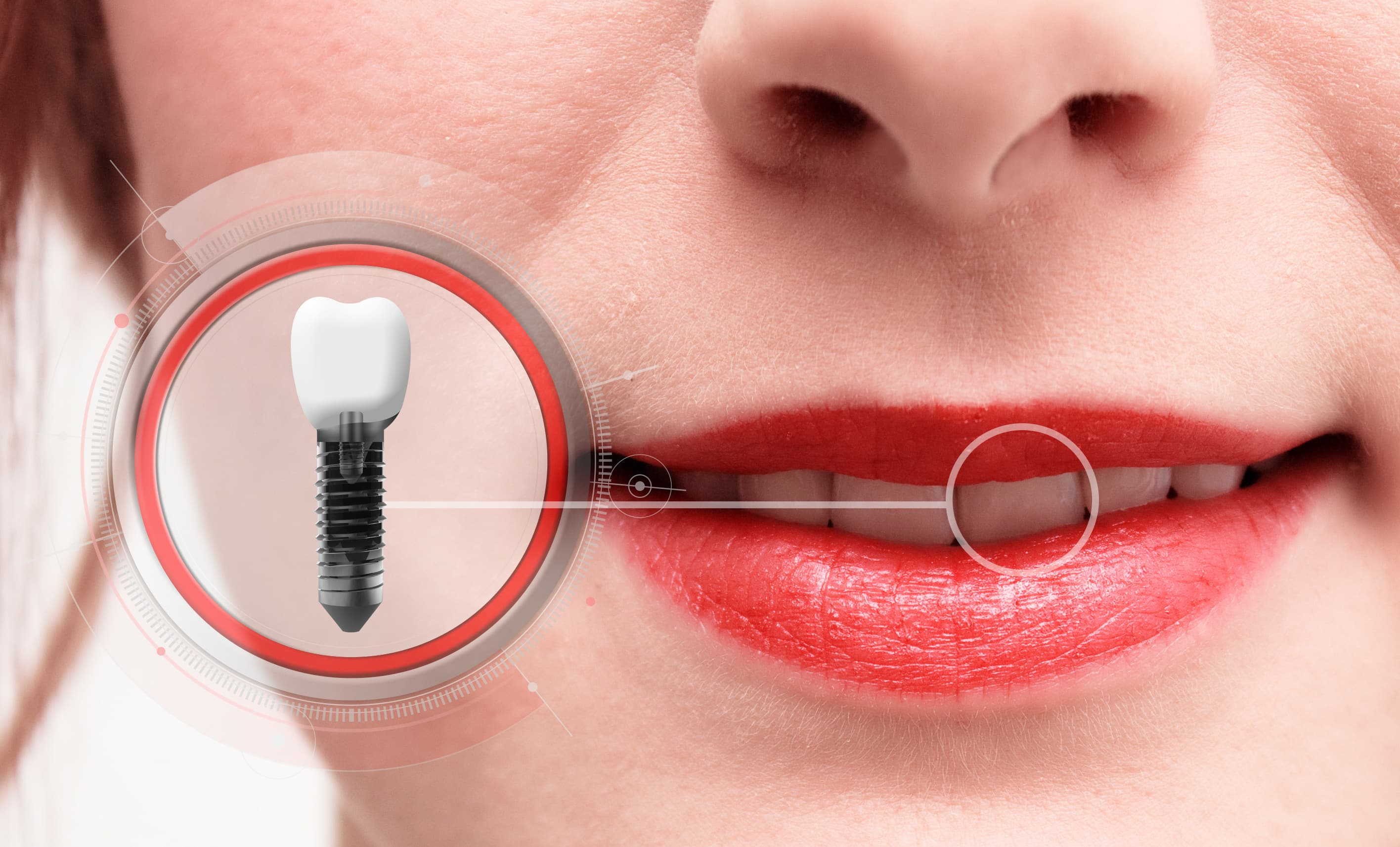 how-do-i-qualify-for-dental-implants