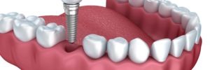 Are Dental Implants Better