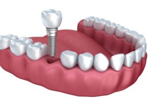 Are Dental Implants Better