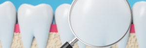 white fillings