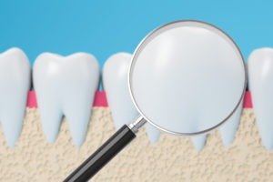 White fillings are indistinguishable from tooth enamel