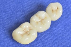 bridge for tooth loss