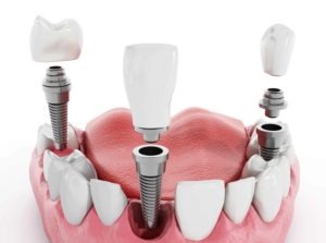How many teeth can implants replace