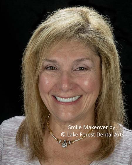 Smile Makeover Process  Simplifying Complex Smile Restorations