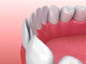 Types of veneers