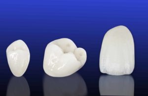 modern dental crowns