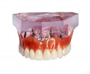 Retain Your Dentures with implants