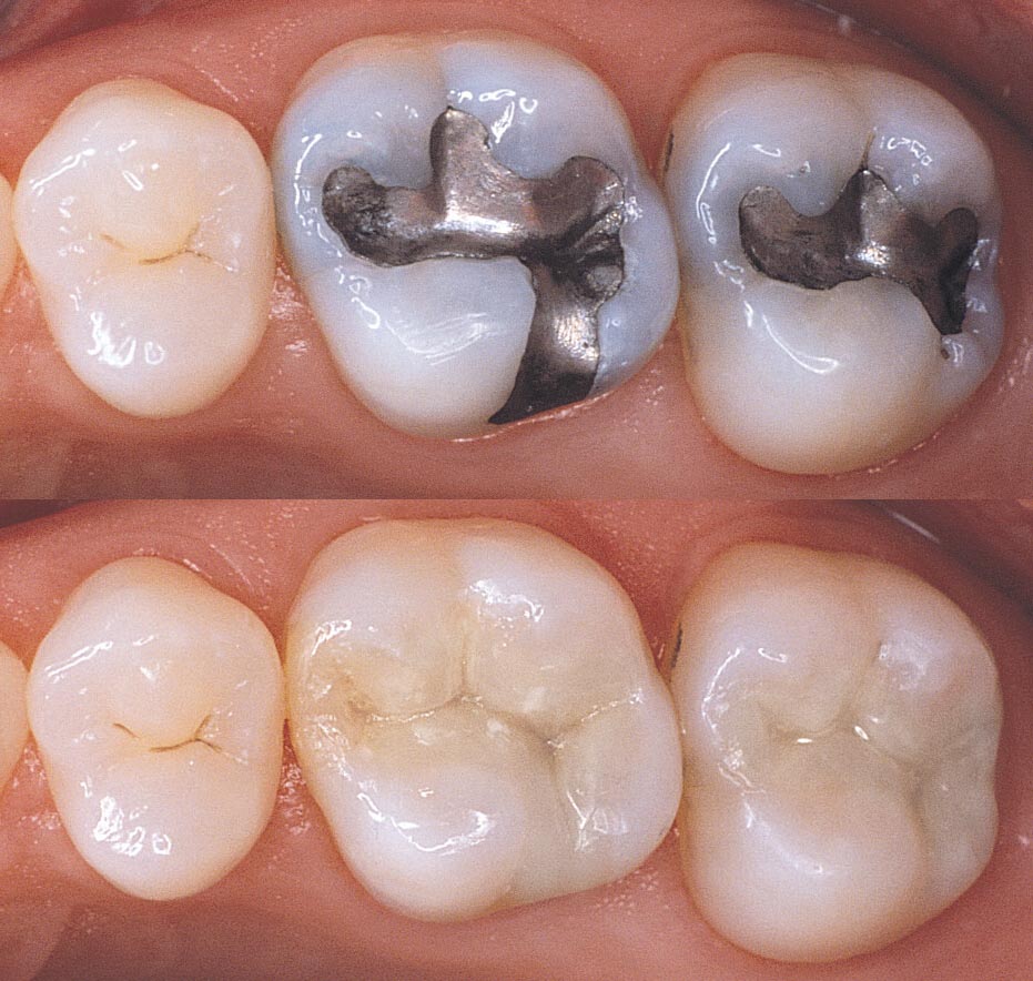 Plastic Fillings  Advantages of Composite Tooth Colored Fillings