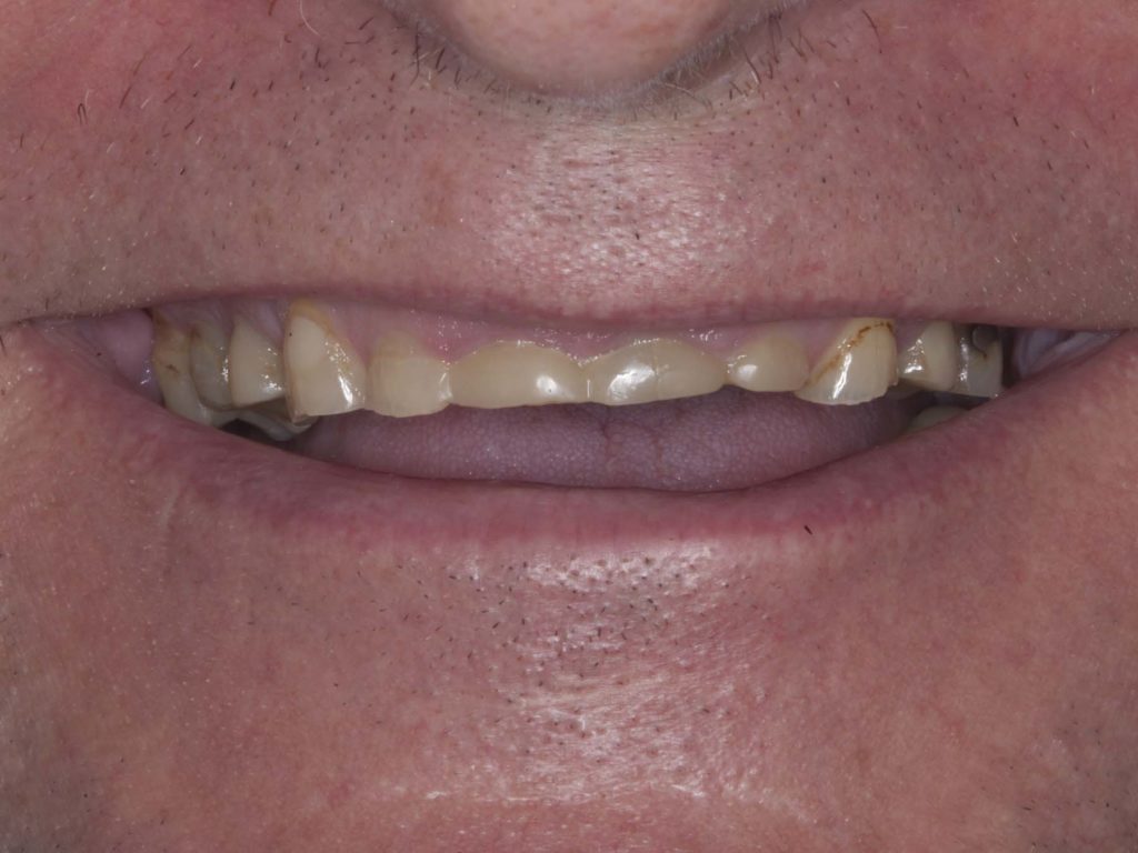 patient with bruxism