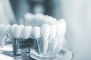 Benefits of Dental Implants