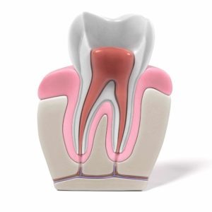 Why do I need a root canal?