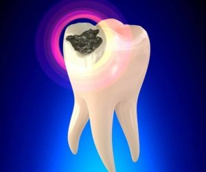 Tooth cavity treatment