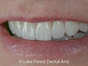 Porcelain smile improvements