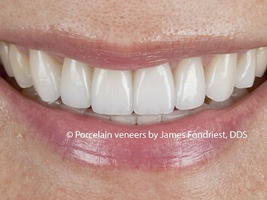 Porcelain veneers, tooth veneers