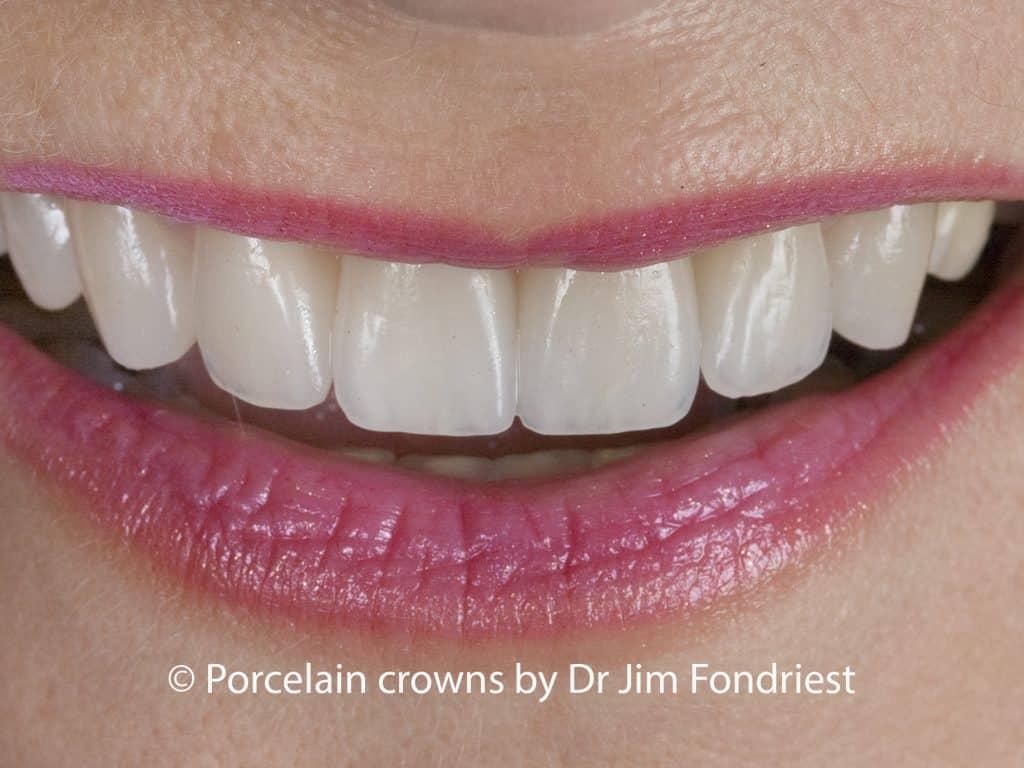 porcelain crowns made from E Max porcelain Porcelain crowns made with E Max